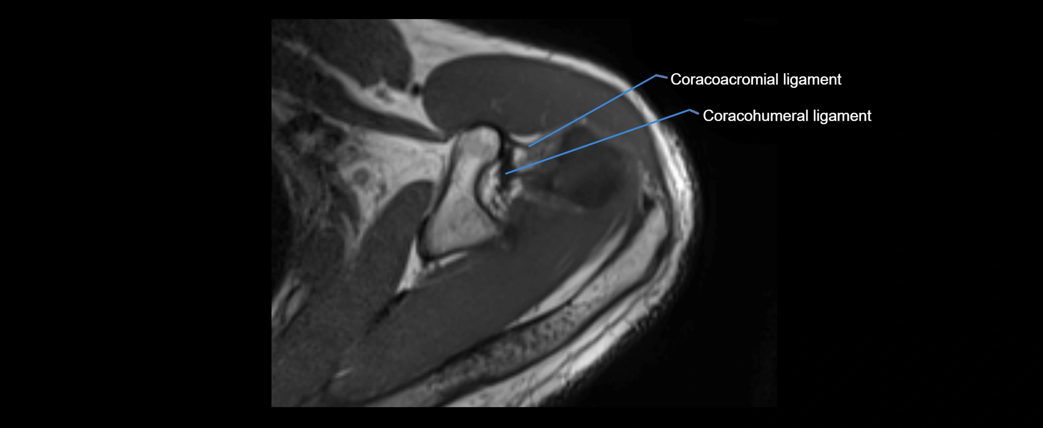 shoulder ligaments axial 3d 3t mri image-img-00005-00040.webp